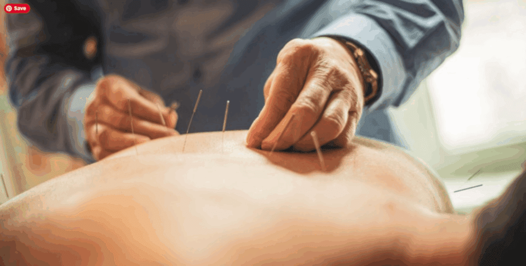 Close-up of a practitioner performing acupuncture, inserting thin sterile needles into a patient’s back during a therapeutic treatment session.